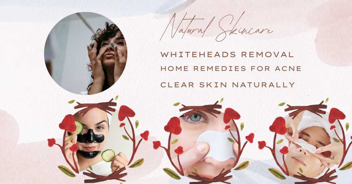 How to Remove Whiteheads And Blackheads Naturally at Home