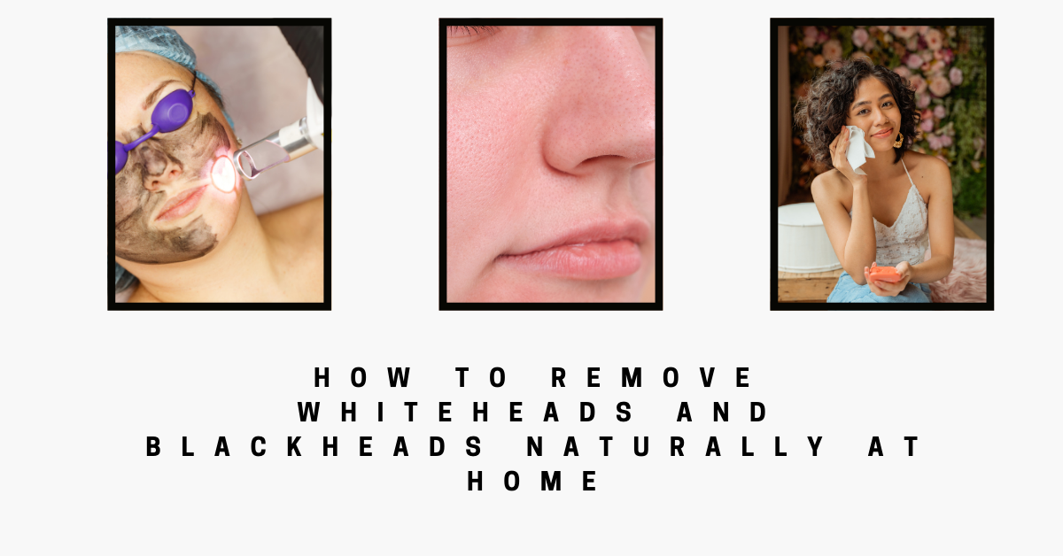 How to Remove Whiteheads And Blackheads Naturally at Home