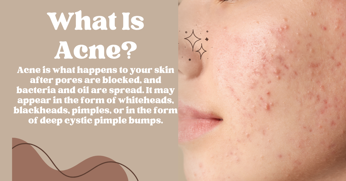 acne tretment