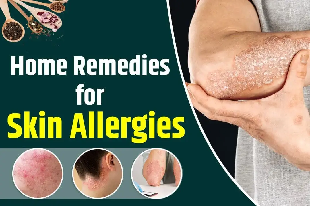 home remedies for skin allergies